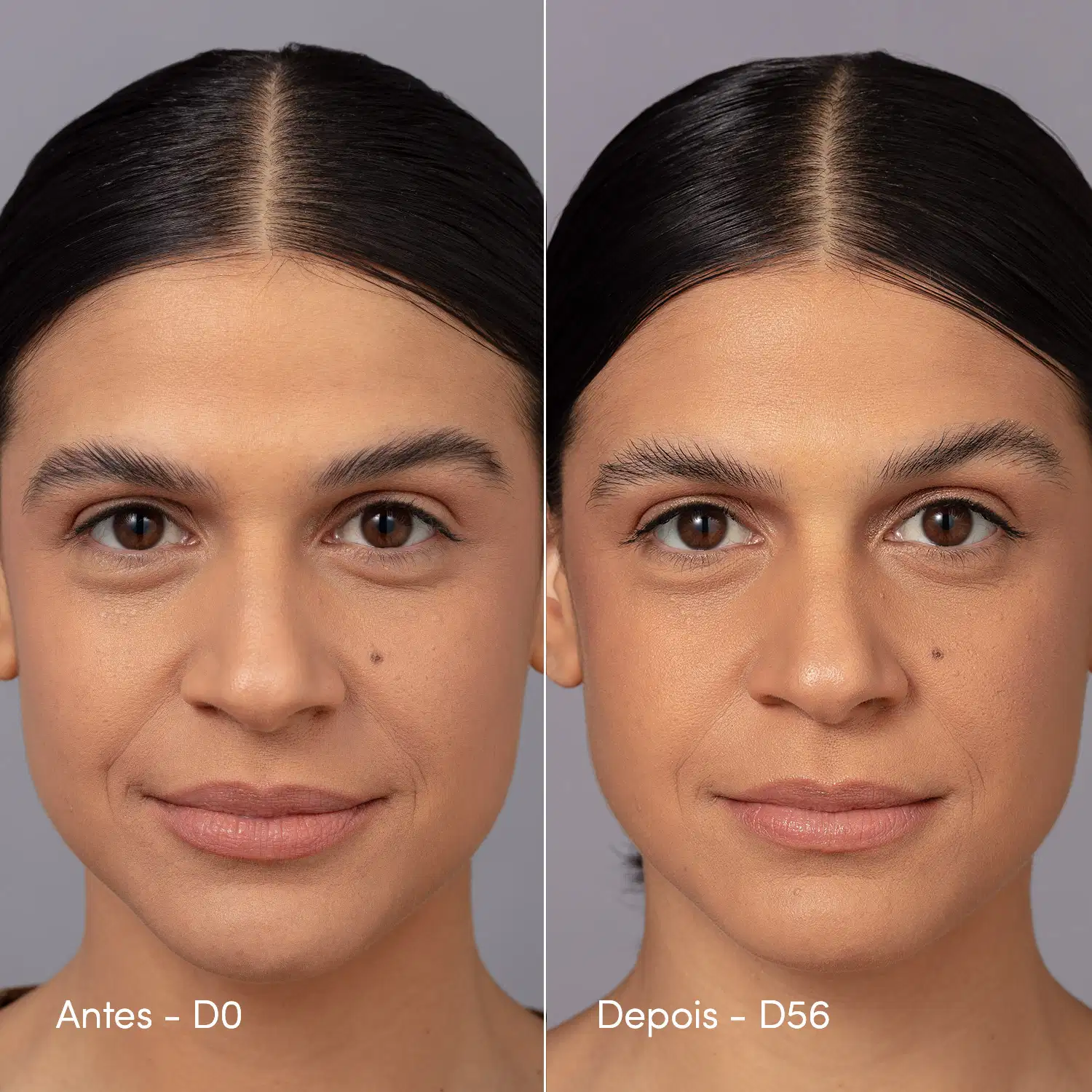 Duas fotos da mesma modelo, indicando o "Antes e Depois", com 56 dias de diferença, indicando as diferenças perceptíveis do uso contínuo do produto de Neo Dermo.