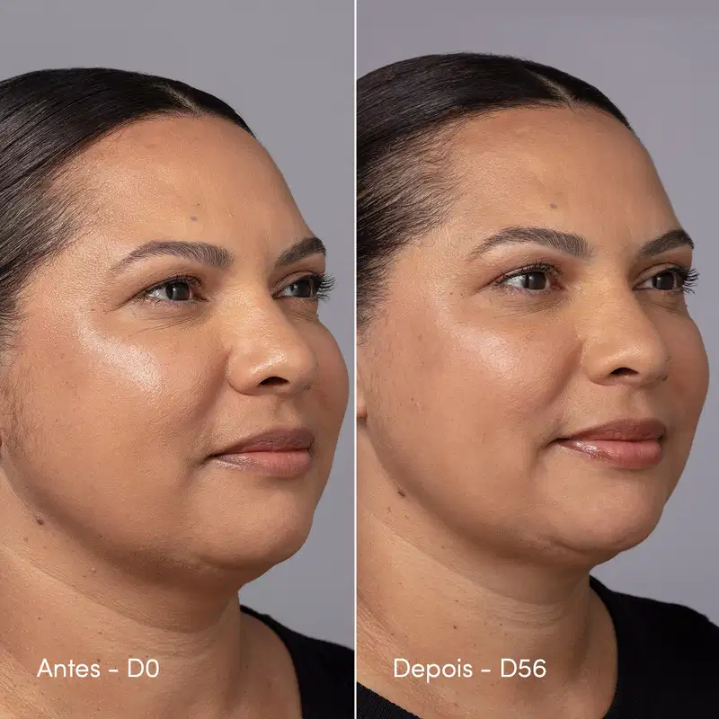 Duas fotos da mesma modelo, indicando o "Antes e Depois", com 56 dias de diferença, indicando as diferenças perceptíveis do uso contínuo do produto de Neo Dermo.