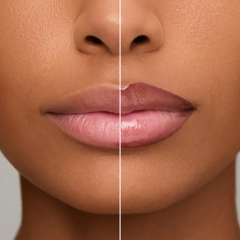 Imagem comparativa de Antes/Depois com o efeito da Lapiseira Labial na região de lábios femininos.
