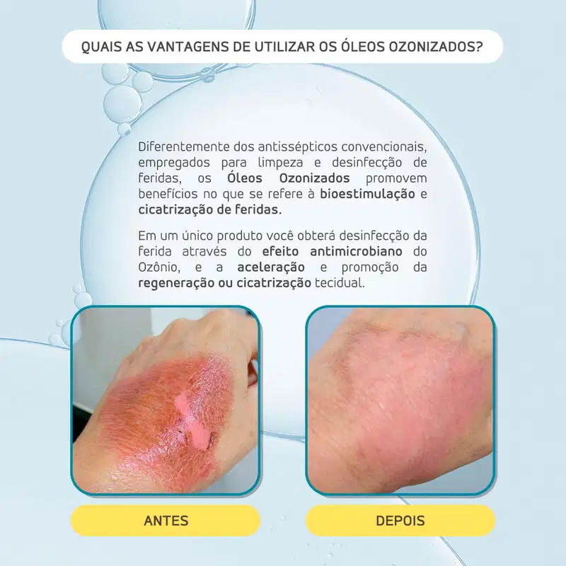 Óleo de Girassol Ozonizado Concentrado Cicatrização Ozonioterapia 30ml